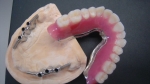 Prothèse résine sur barre Preciline sur implant