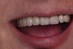 Bridge sur implant en bouche